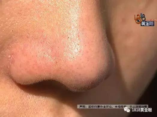 最新双眼皮手术费用